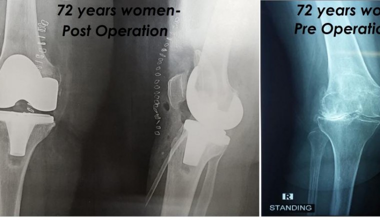 Age Is Just a Number: Elderly Man and Woman Combat Osteoarthritis through a Surgical Procedure