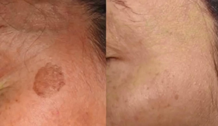 Innovative Treatment Helps Individuals in the UAE Combat Skin Irregularities and Unwanted Tattoos